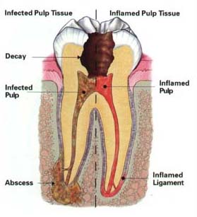 endodontics tooth illustration