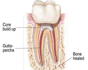 endodontics tooth illustration signs and symptoms