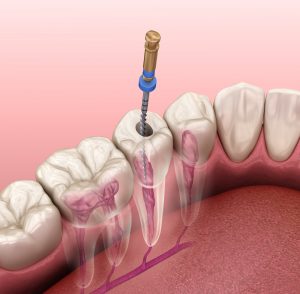 Root Canal London